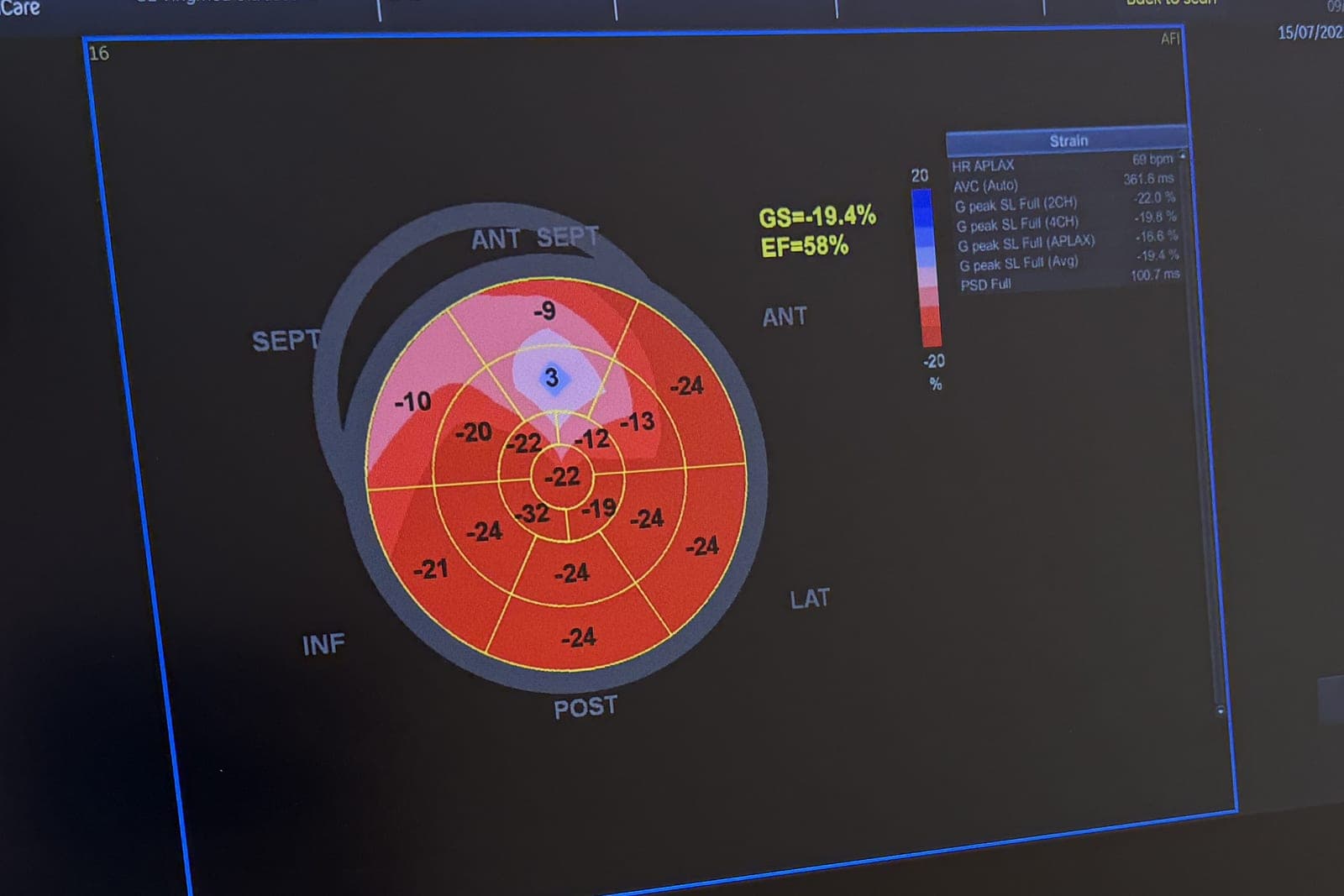 Strain / Speckle tracking