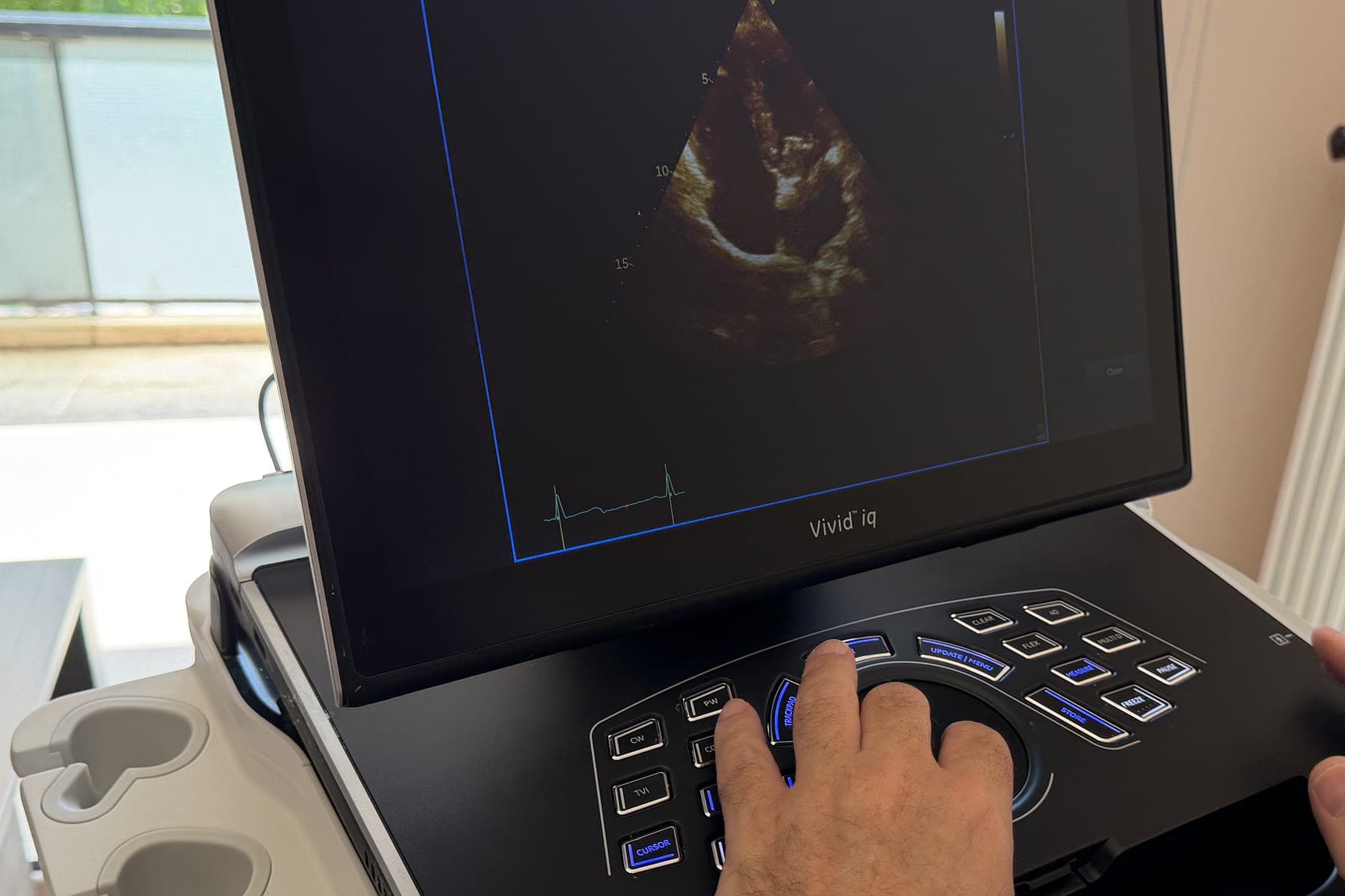 Υπερηχογραφικό σύστημα GE Vivid iq κατά τη διάρκεια καρδιολογικής εξέτασης